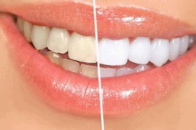 Зубы после снятия зубного налета