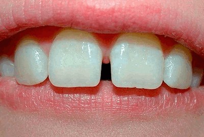 Со временем зубы начинают двигаться, обнажаются шейки зубов, появляются межзубные щели