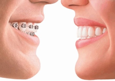 Ортодонтия занимается исправлением прикуса из-за неправильно расположенных зубов