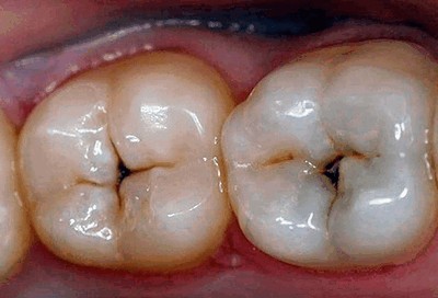 Пульпит зуба лечение